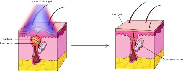 Acnediagram_8eda8f94-1cf3-4bb3-a26b-6000c24ab039_1024x1024@2x